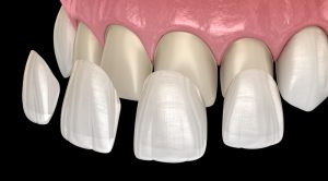 porcelain veneer placed in mouth