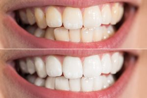 before & after of teeth whitening