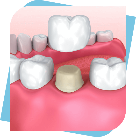 3d rendering of a dental crown