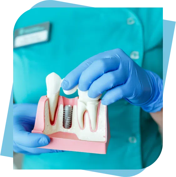 dental model of a dental implant