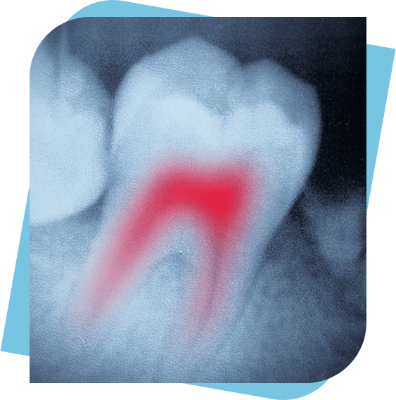 X-Ray of an infected tooth