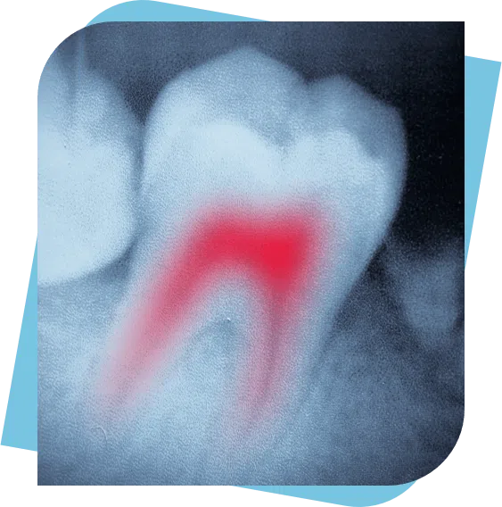 X-Ray of an infected tooth