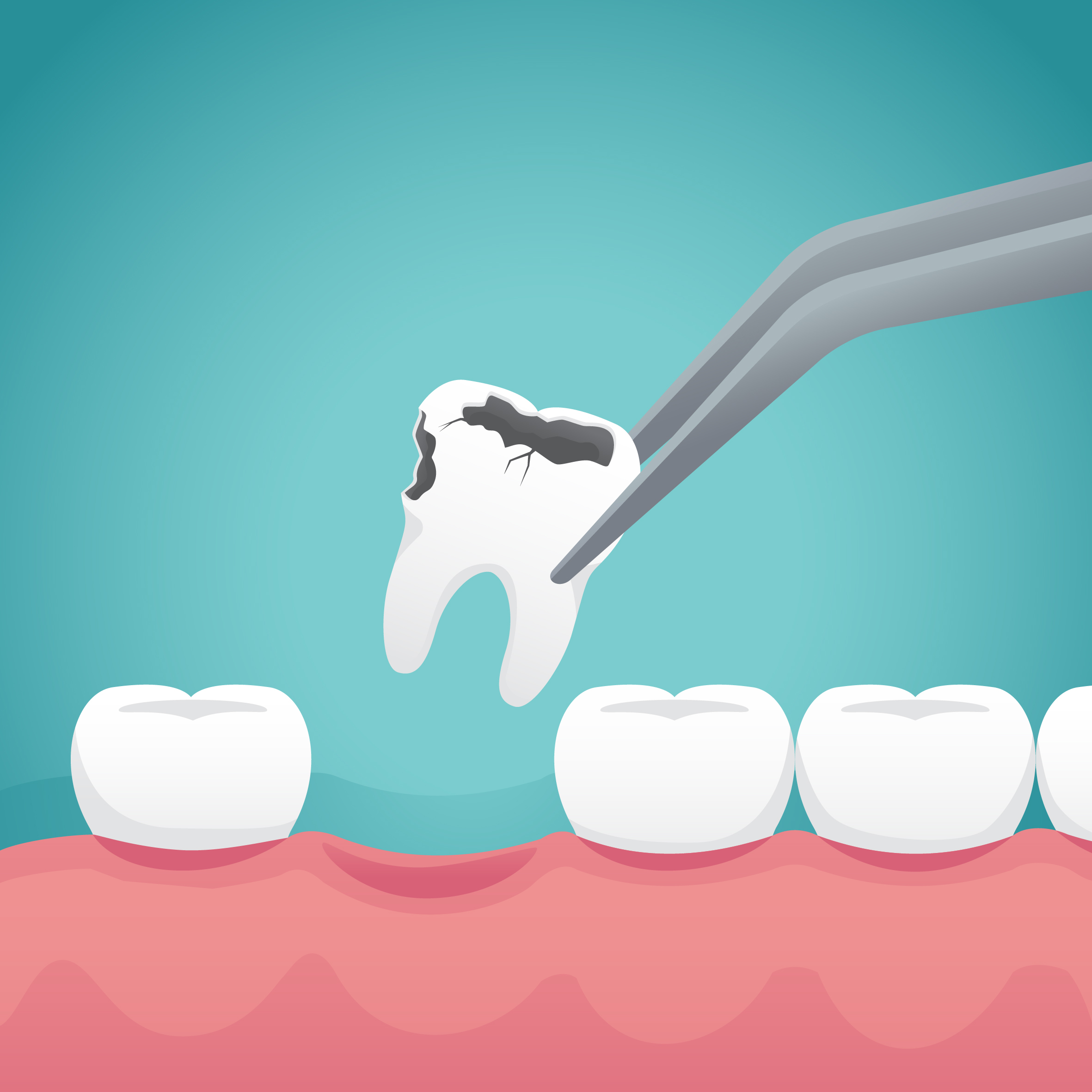 tooth extraction animation