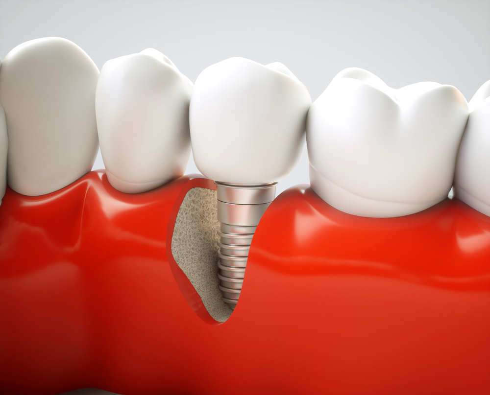 animation of dental implants