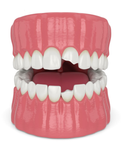 image of mouth with two chipped teeth